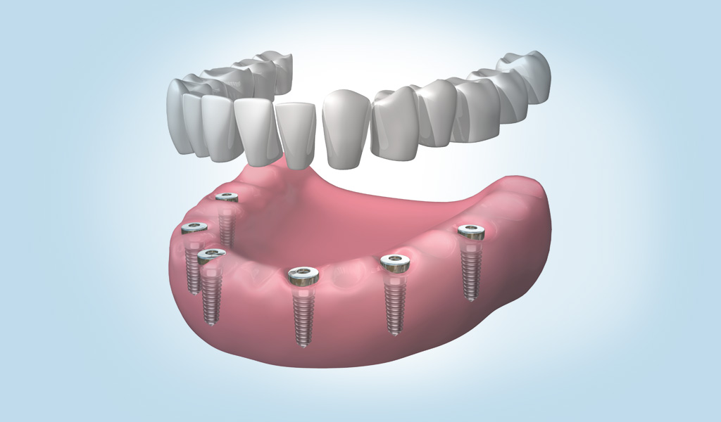 Implantes dentales en Martorell