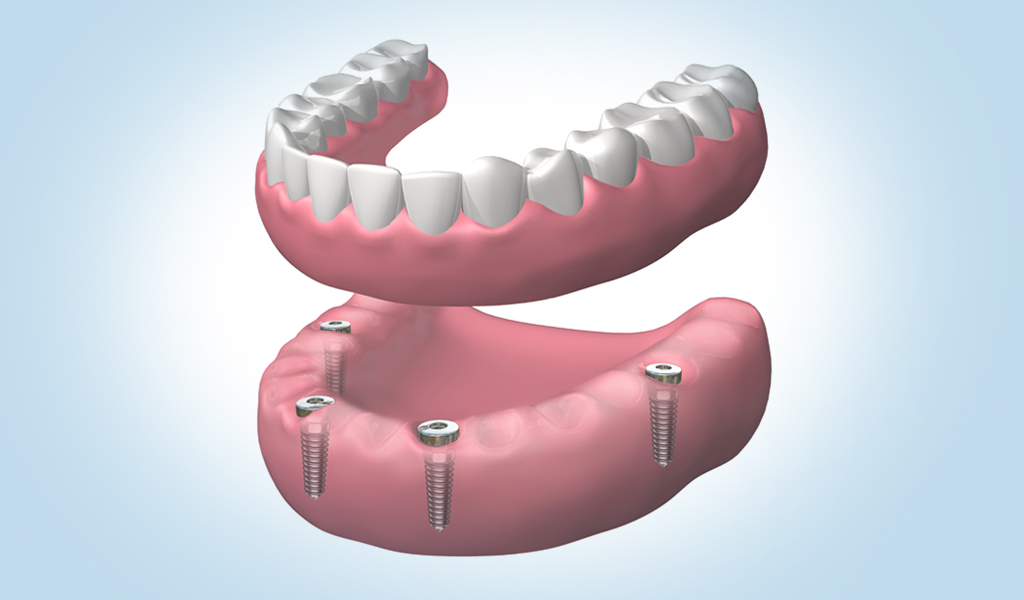 Implantes dentales en Martorell
